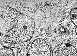 M,7y. | medulloblastoma M,7y. | medulloblastoma